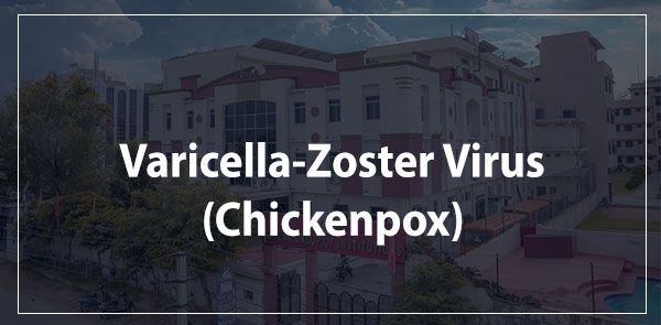 Varicella-Zoster Virus (Chickenpox)